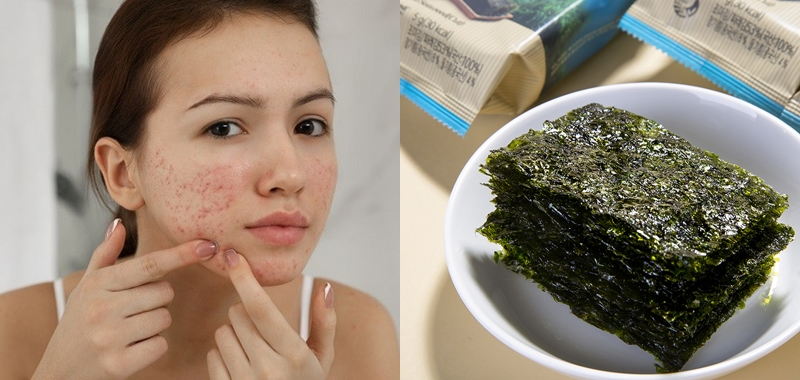 Rong Biển Ăn Liền Có Nóng Không? Giải Mã Sự Thật Và Cách Ăn Không Nổi Mụn